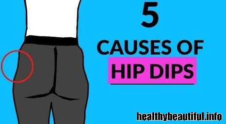Unveiling the Causes of Hip Dips: What's Behind this Natural Phenomenon