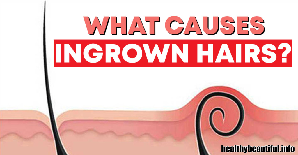 What Are Ingrown Hairs Caused From? Exploring the Origins