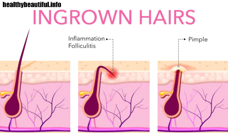Ingrown Hair Bumps in the Pubic Area: What's Behind Them?
