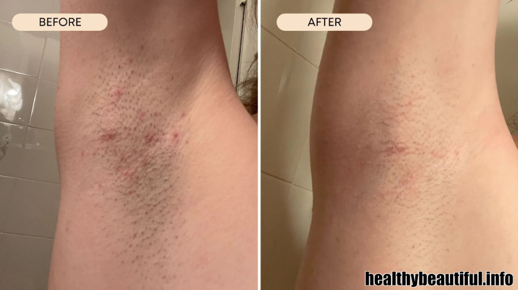 Unveiling the Mysteries: What Causes Ingrown Hair in the Armpit