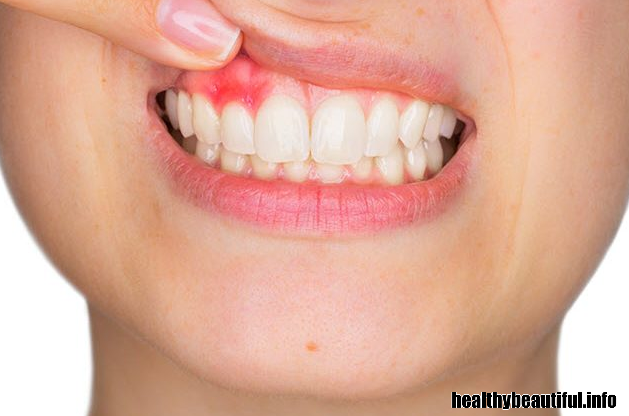 YOUR GUMS SWELL AND BLEED EASILY